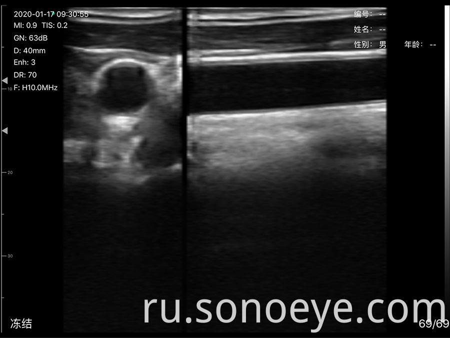 porket ultrasound